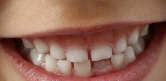 Barázdazárással a fogszuvasodás ellen