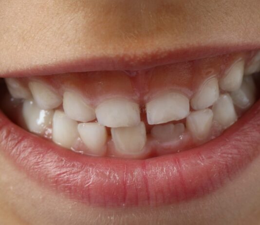 Barázdazárással a fogszuvasodás ellen