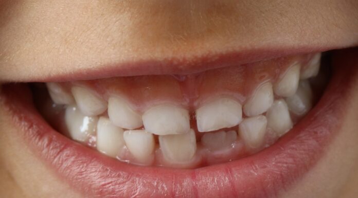 Barázdazárással a fogszuvasodás ellen